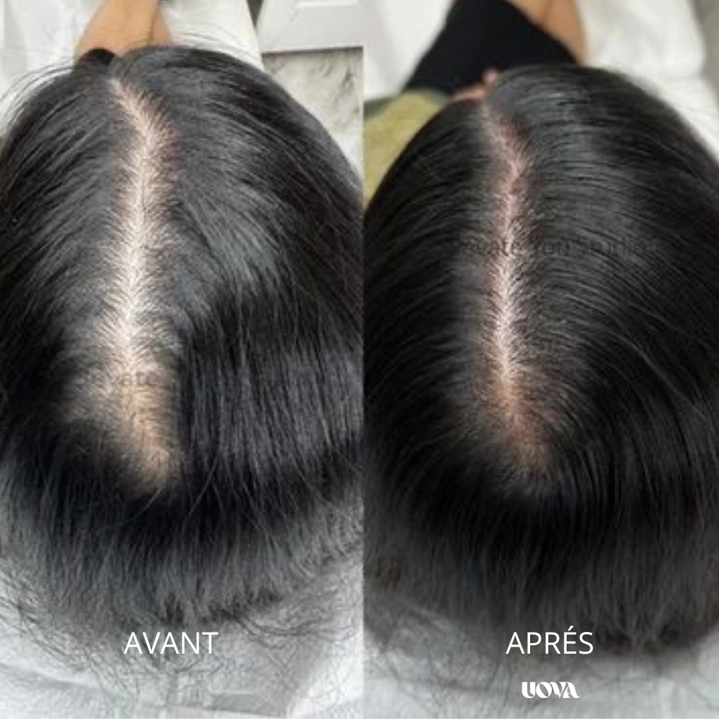 UOVA – Infusion naturelle anti-SOPK
