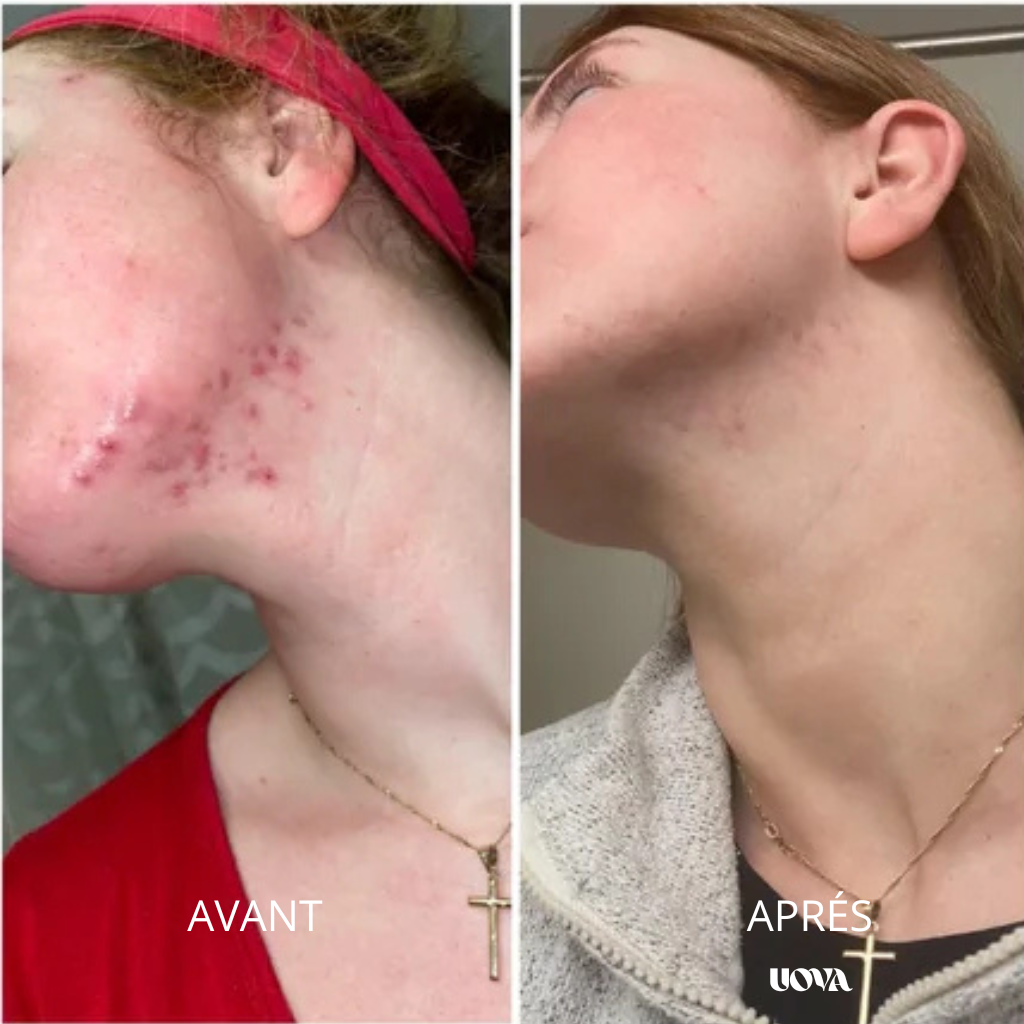 UOVA – Infusion naturelle anti-SOPK