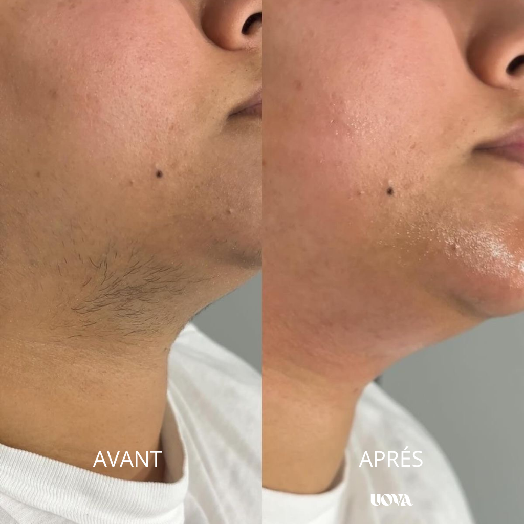 UOVA – Infusion naturelle anti-SOPK